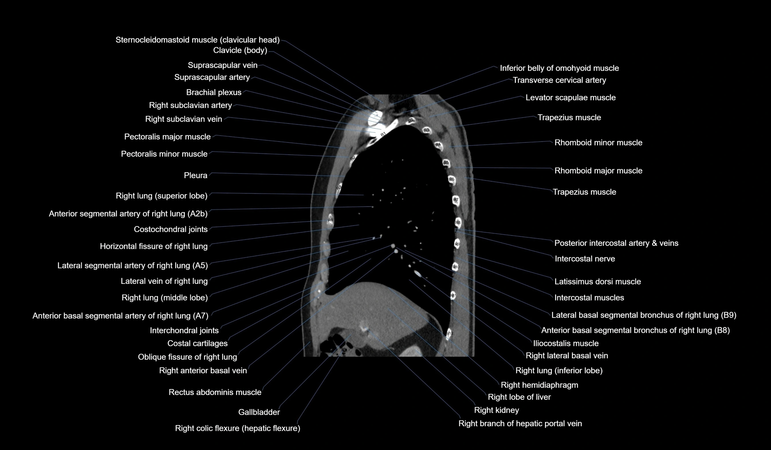 CT chest (thorax) labelled sagittal cross sectional anatomy radiology image-00047.webp